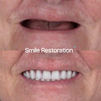 Missing All Teeth